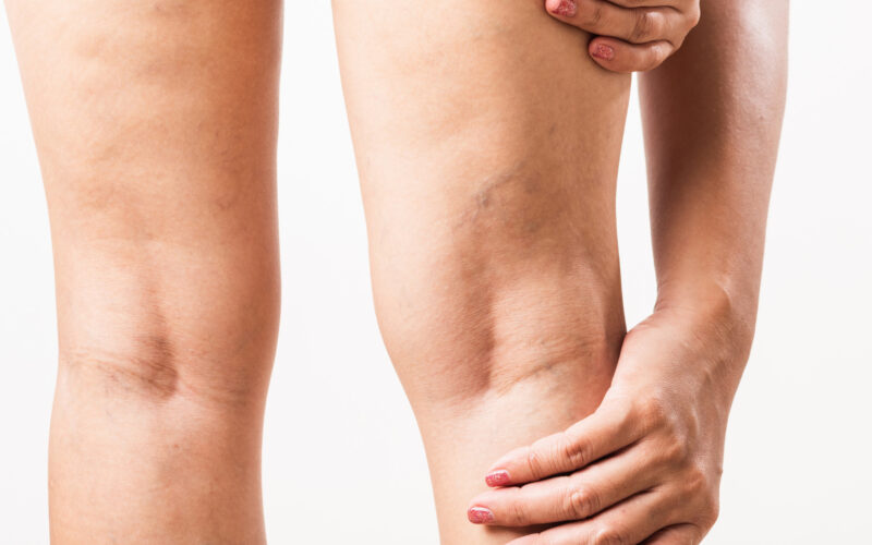 Insuficiencia venosa crónica: síntomas y su impacto en la salud vascular